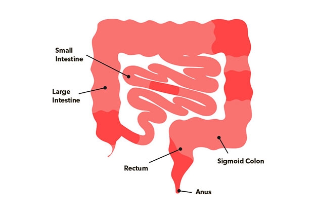 Crohn’s Disease