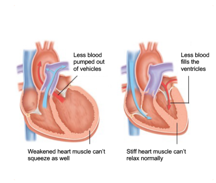 Heart failure is a term used to describe a heart that cannot keep up with its workload. 